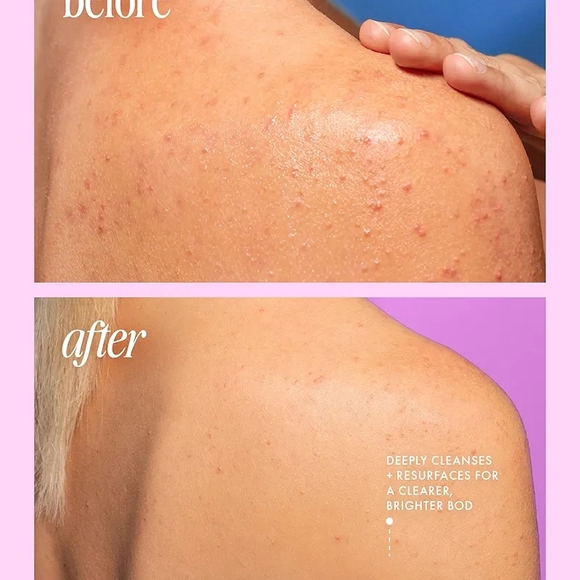 Truly Beauty - Cherry Jelly Anti Bacne Body Cleanser - Picture 3 of 5